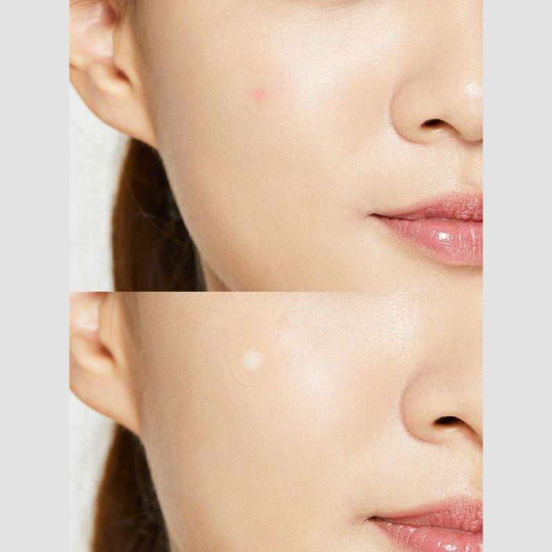 COSRX Acne Pimple Master Patch Hydrocolloid Spot Treatment for Overnight Use Blemish Cover Stickers for Whiteheads & Pimples